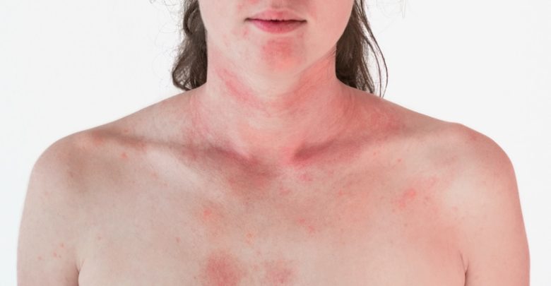 Sun Poisoning Types Symptoms And Treatment Global Healthcare Guide