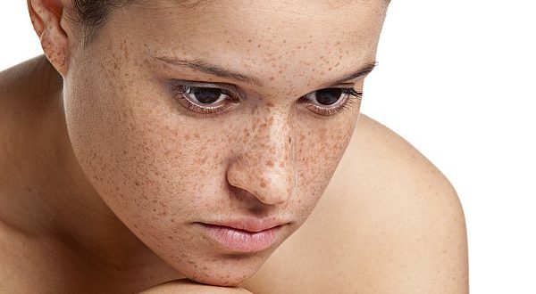 How to deal with freckled skin