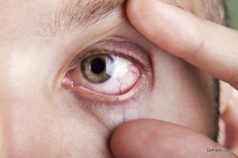 Dry-eye-syndrome