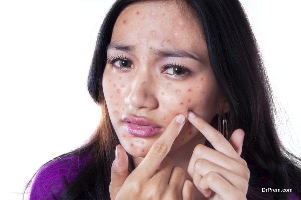 Acne on face