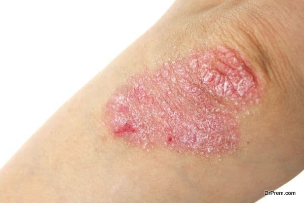 Psoriasis, the skin ailment