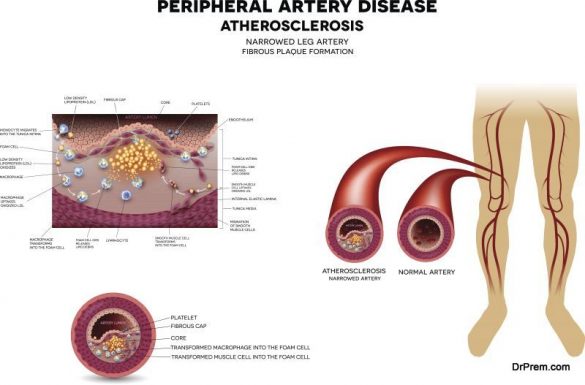 How Concerning Is PAD (Peripheral Arterial Disease) And What You Can Do ...