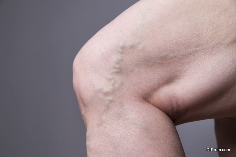 Thread Veins and Varicose Veins