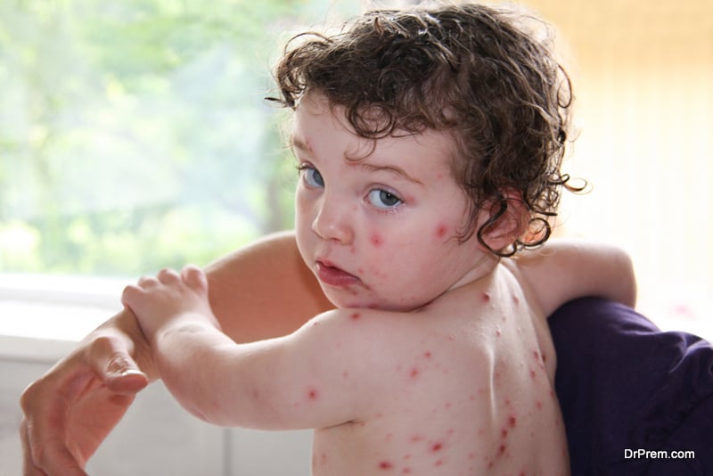 How to deal with chicken pox
