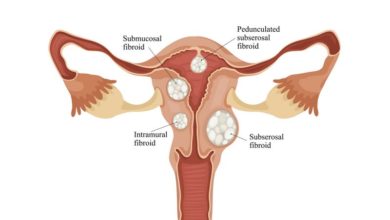 uterine-fibroid-diagnosis-and-treatments
