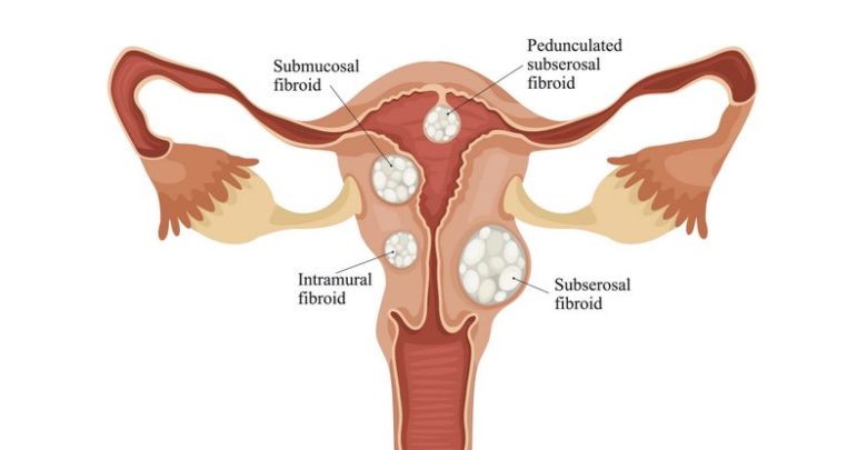 A Complete Guide To Uterine Fibroid Diagnosis And Treatments Using Conventional And Holistic