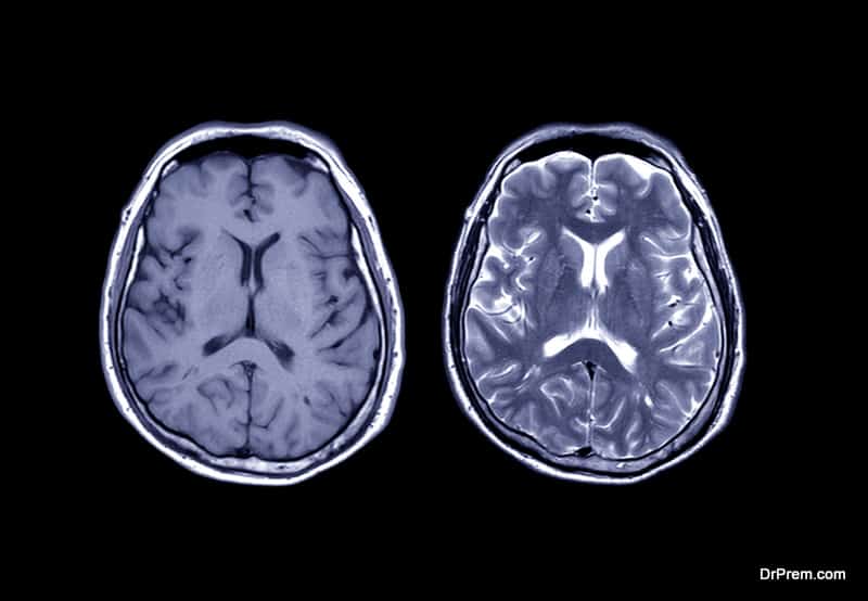 swelling in the brain