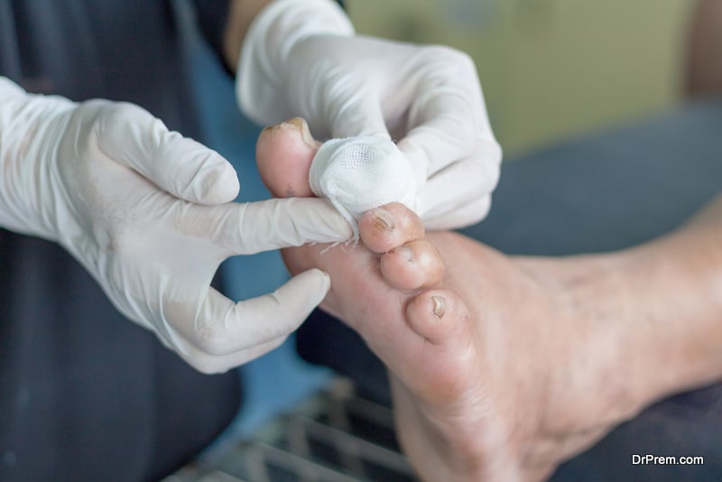 Prevent Diabetic Foot From Getting Amputated
