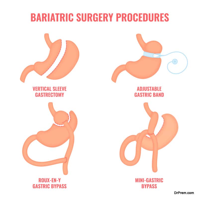 Bariatric surgery weight loss procedures medical infographics