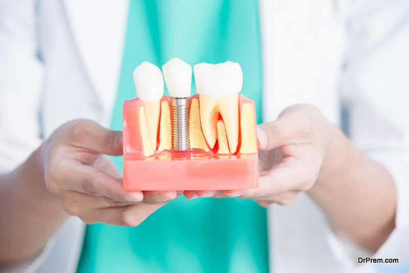 Benefits of Dental Implants Over Dentures