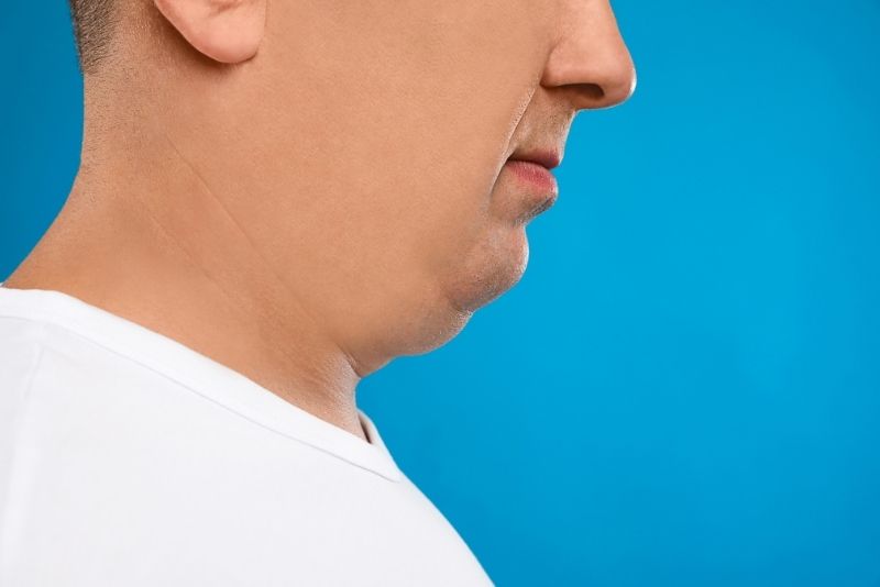 Cause of Double Chin