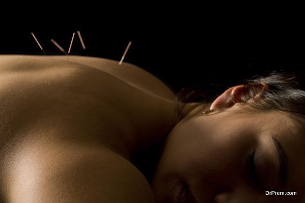 Acupuncture