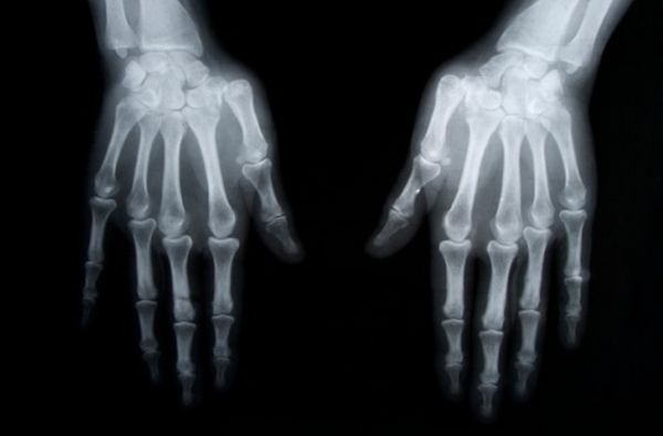 Osteoporosis_hand x-ray