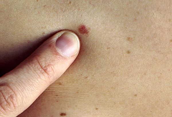 PRinc_photo_of_skin_cancer_screening (1)