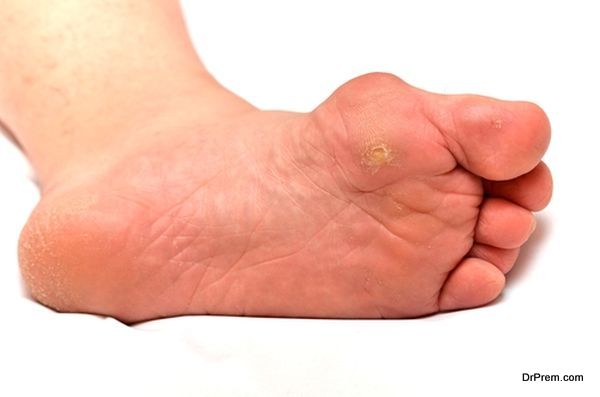 Corn plasters, the best solutions for your foot problem - Health Guide ...