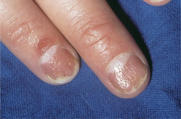 Small pits in nail