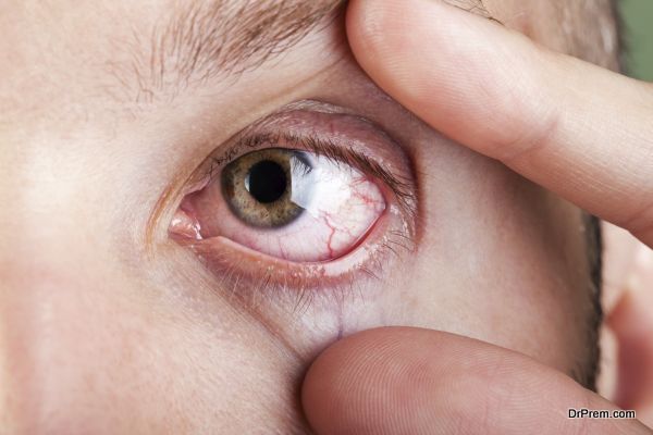 Dry eye syndrome and how you can deal with it - Health ...