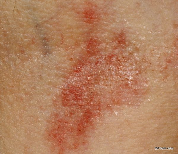 allergic rash dermatitis skin