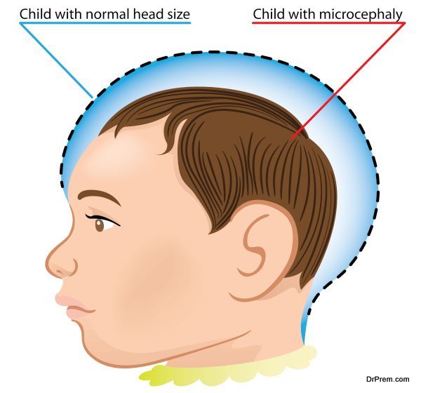 Microcephaly