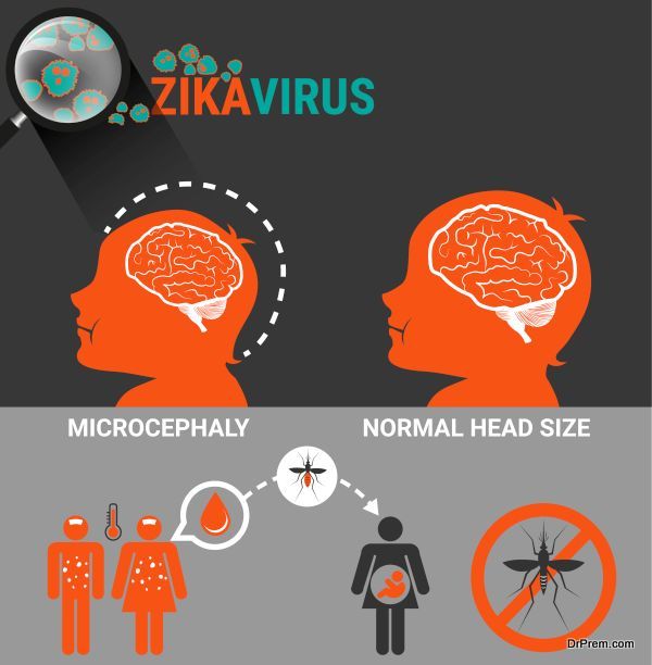 Pregnant Women with baby microcephaly and Zika Virus