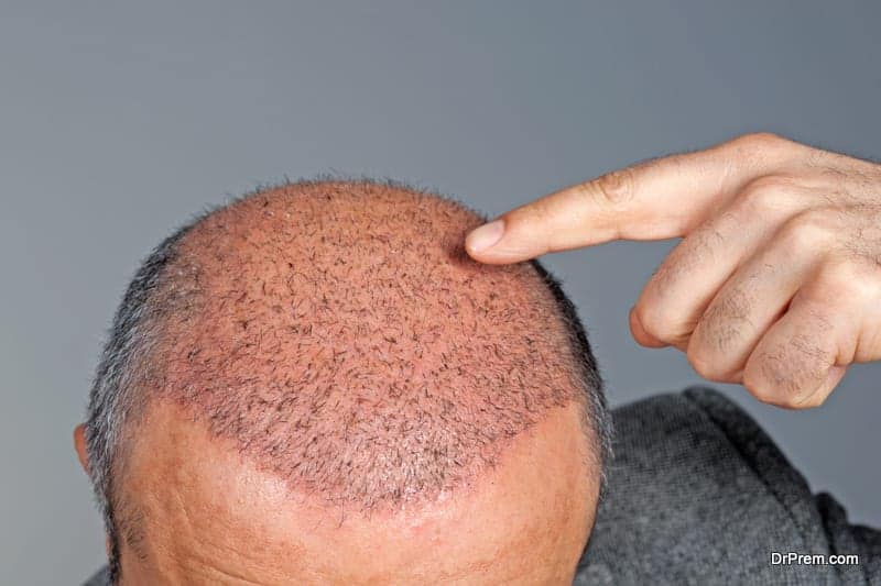 Do The Popular Hair Loss Treatments Work