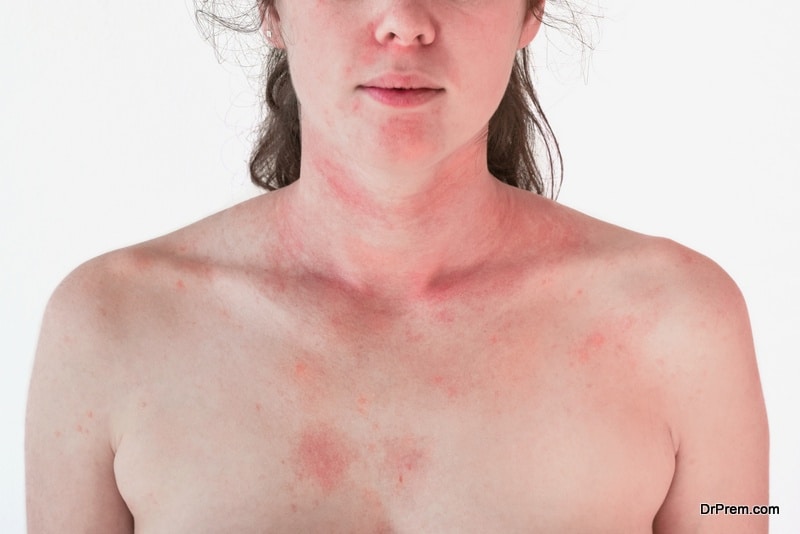 Sun poisoning