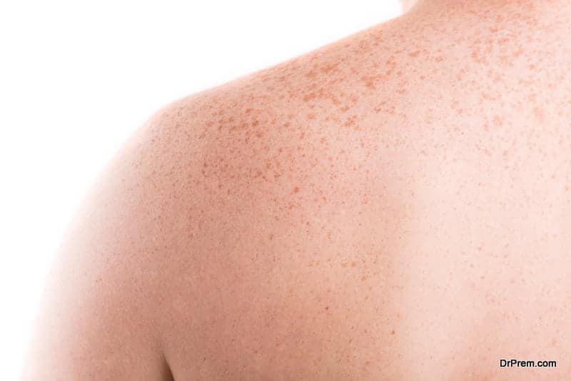Skin Pigmentation