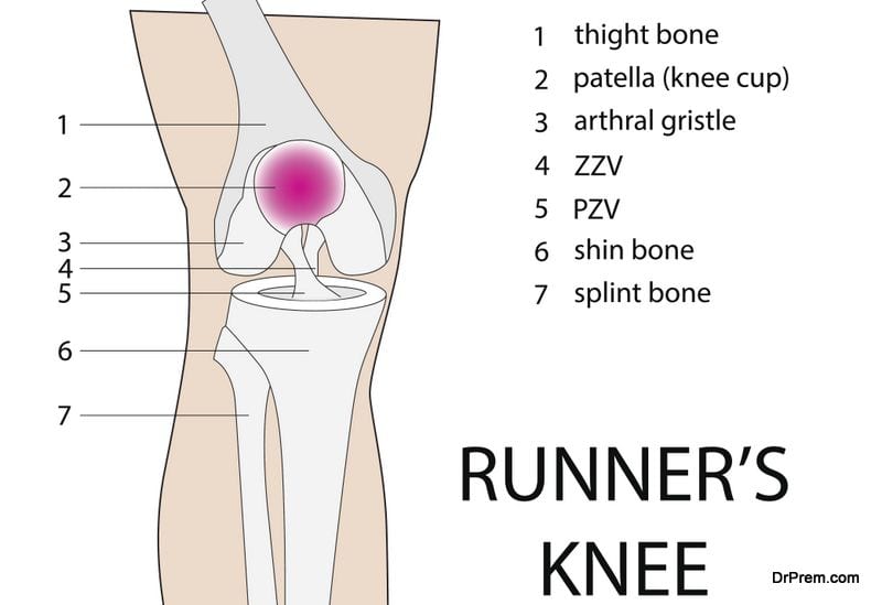 ACL Tear