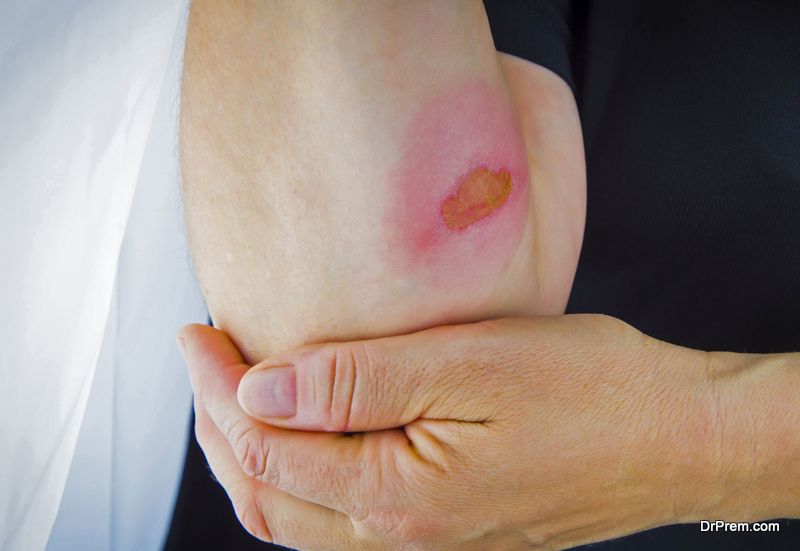 It is possible to deal with minor burns and scalds