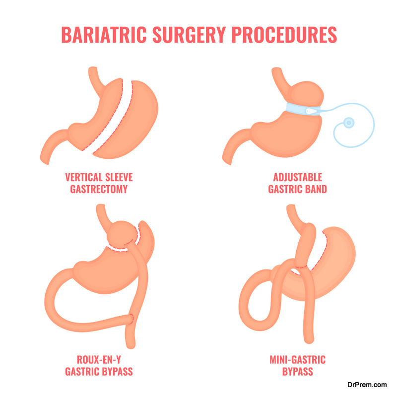 A Comprehensive Guide To Weight Loss Surgery In Medical Tourism Types Destinations And Things