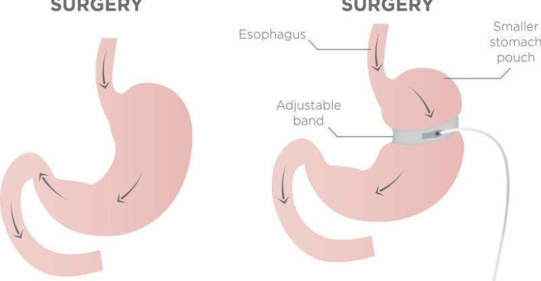 gastric band surgery essex