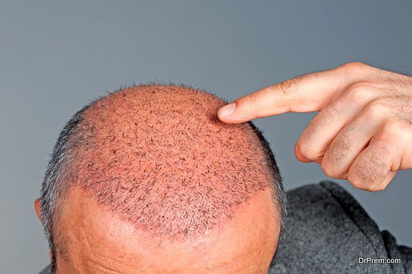 Hair Transplantation procedure