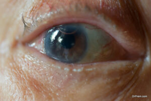 the vision disorder due to a misshapen cornea is