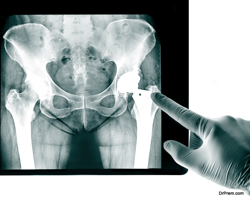 X-ray of the pelvis Endoprosthesis, the socket of the hip joint used for Hip Joint rheumatic diseases and Rheumatoid Arthritis