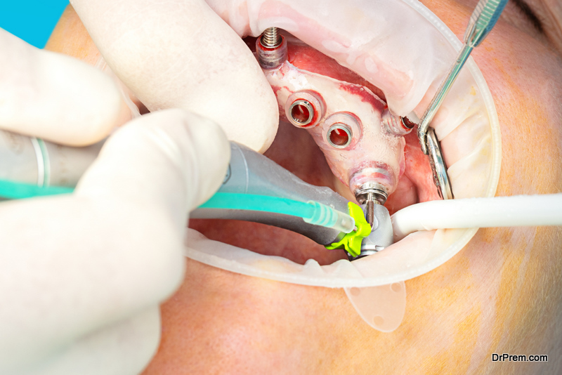 digital guided implant surgery on patient - new implant technology in dentistry