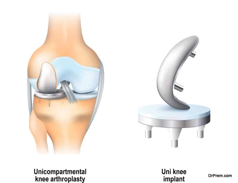 Knee Replacement procedure