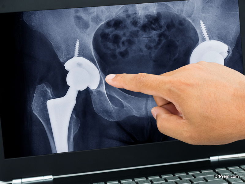 xray photos of total hip replacement in medical application