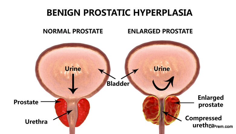 Benign Prostatic Hyperplasia 780x444 