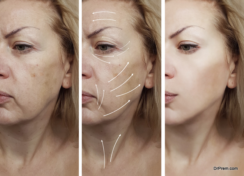 woman face wrinkles before and after procedures