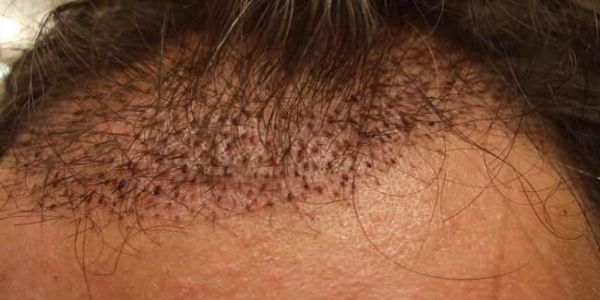 Reduce-Swelling-After-Hair-Transplant-th