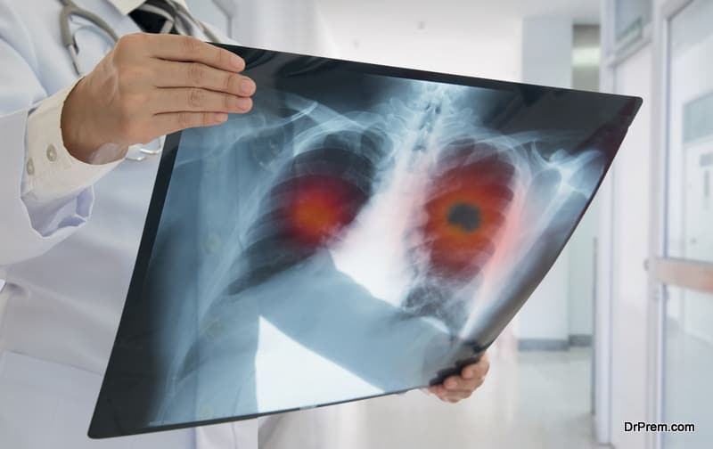 X-ray lung cancer