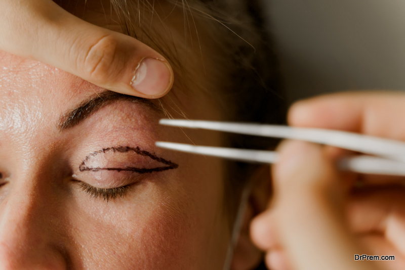 Blepharoplasty markup close-up on the face before the plastic surgery operation for modifying the eye region of the face in medical clinic. 2 doctors do plastic cosmetic operation