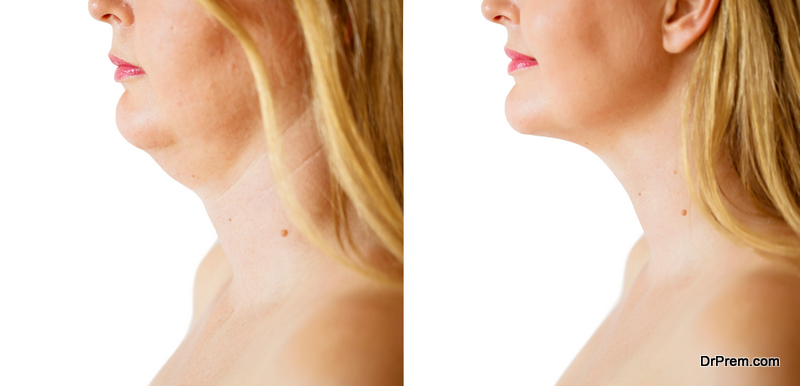 Woman-before-and-after-chin-fat-correction-procedure