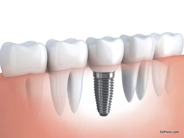 Tooth human implant (done in 3d graphics)