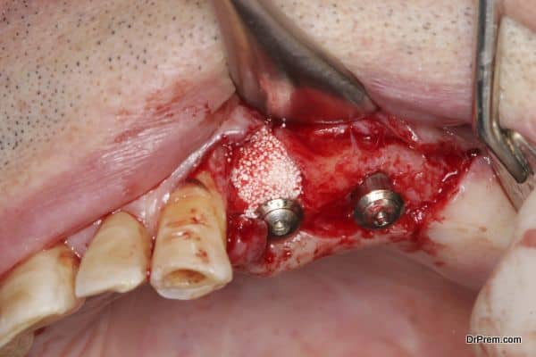 dental implant