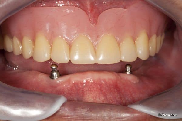 dental implants (7)