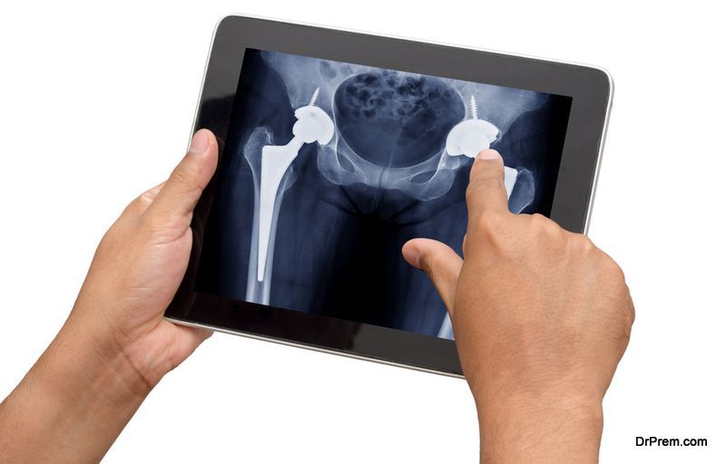 Doctor checking x ray of patient who have both side total hip replacement in tablet 