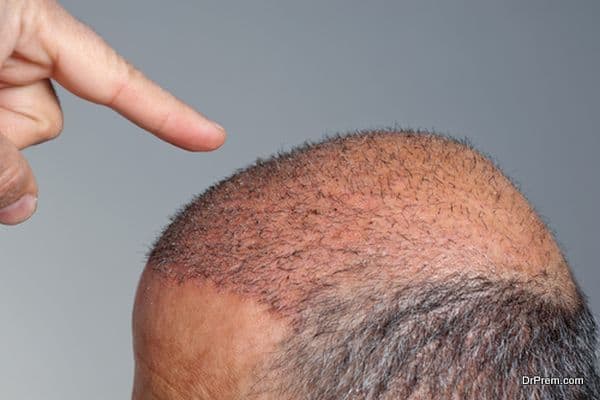 Hair Transplant destinations (5)