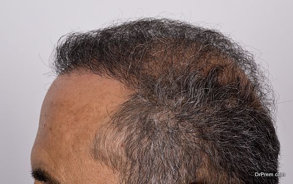 Hair Transplant destinations (7)