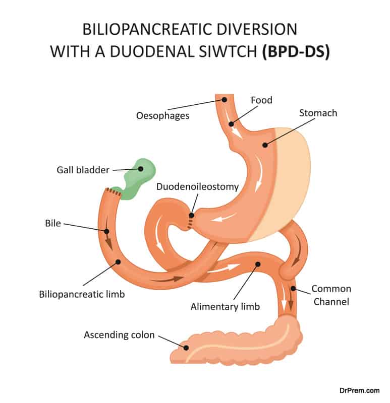 Biliopancreatic Diversion With a Duodenal Siwtch (BPD-DS)